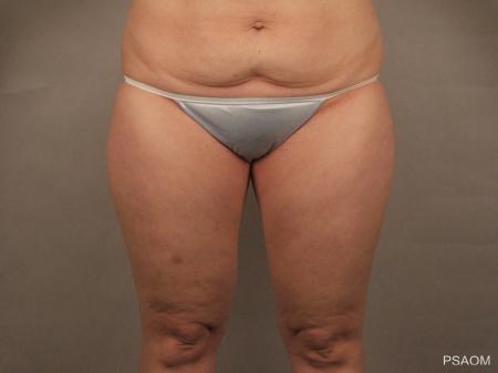 Liposuction: Patient 3 - Before Image 1