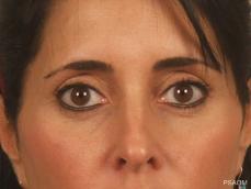 Eyelid Lift: Patient 2 - After Image