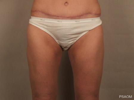 Liposuction: Patient 3 - After Image 1