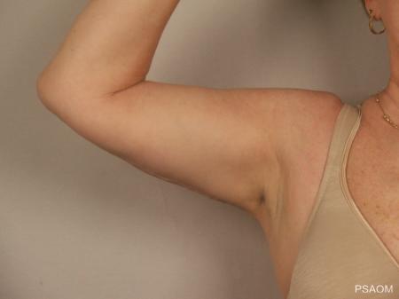 Arm Lift: Patient 1 - After Image 3