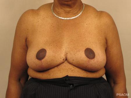Breast Reduction: Patient 1 - After Image