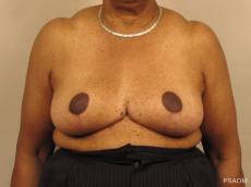 Breast Reduction: Patient 1 - After Image