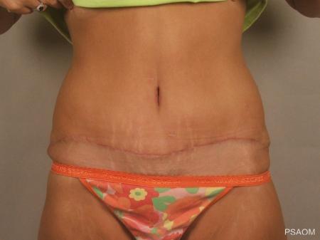 Tummy Tuck: Patient 4 - After Image