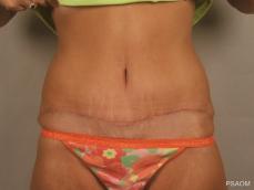 Tummy Tuck: Patient 4 - After Image