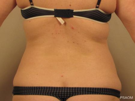 Liposuction: Patient 4 - Before Image