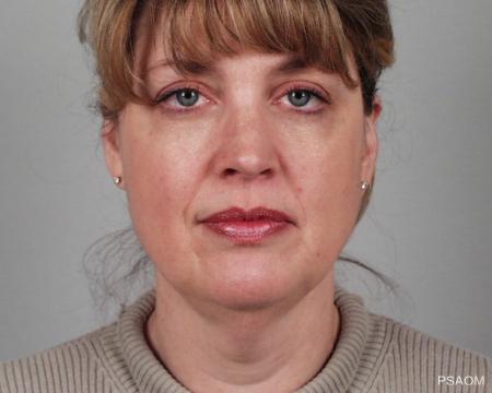 Facelift: Patient 1 - Before Image