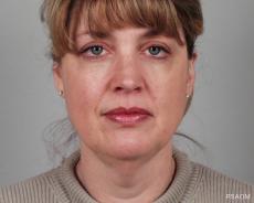 Facelift: Patient 1 - Before Image