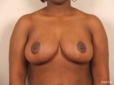 Breast Reduction: Patient 12 - After Image