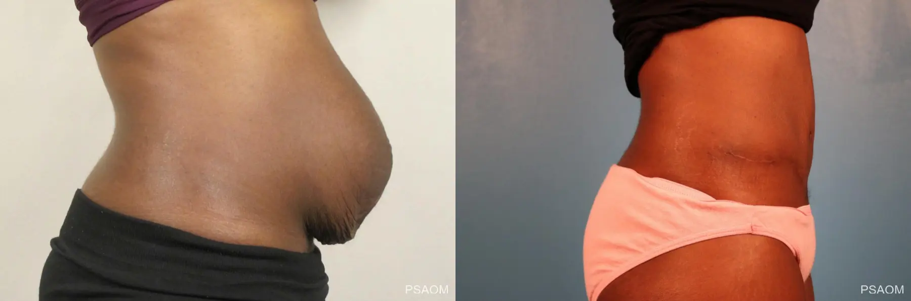 Abdominoplasty: Patient 1 - Before and After  