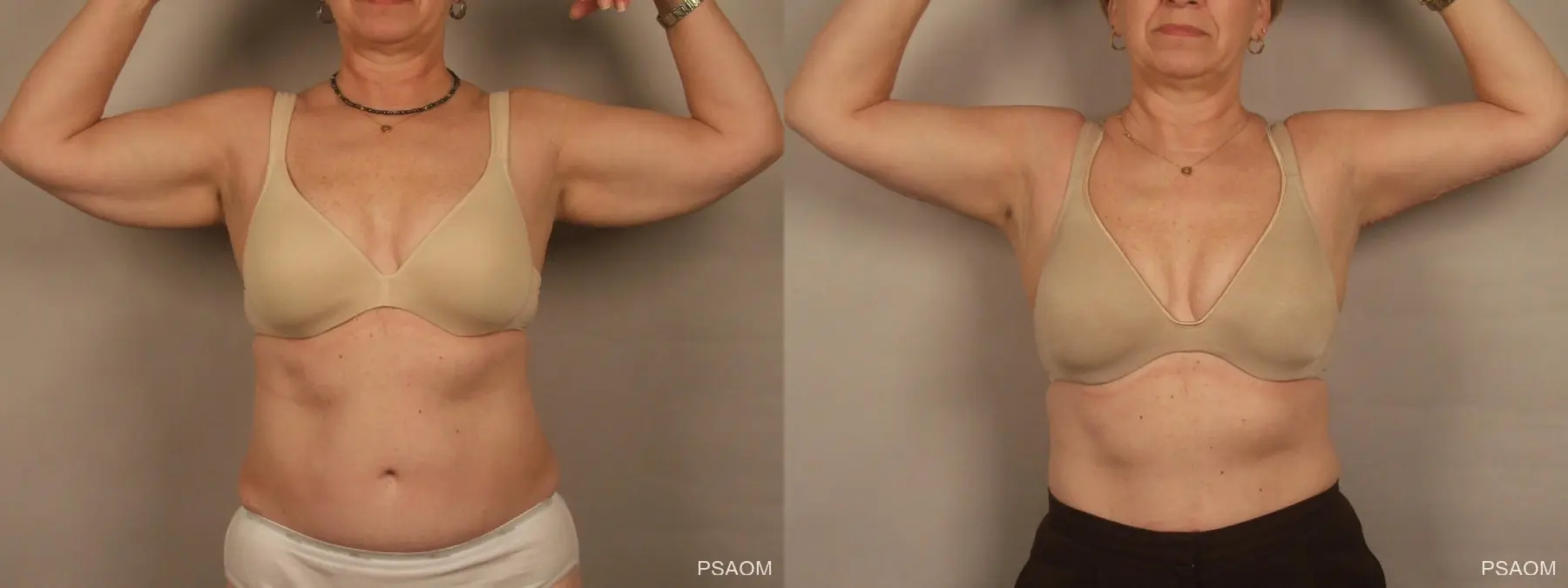Arm Lift: Patient 1 - Before and After 1