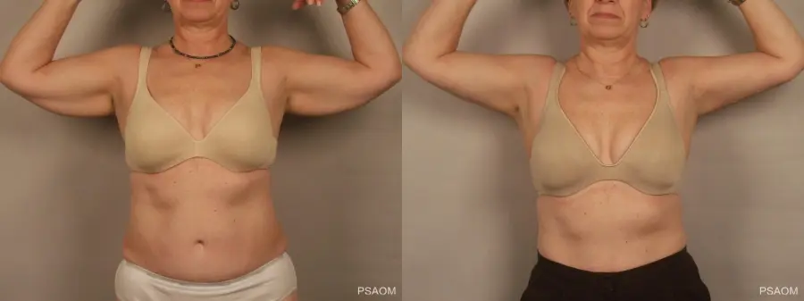Arm Lift: Patient 1 - Before and After  