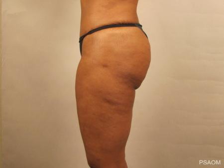 Liposuction: Patient 1 - After Image 2