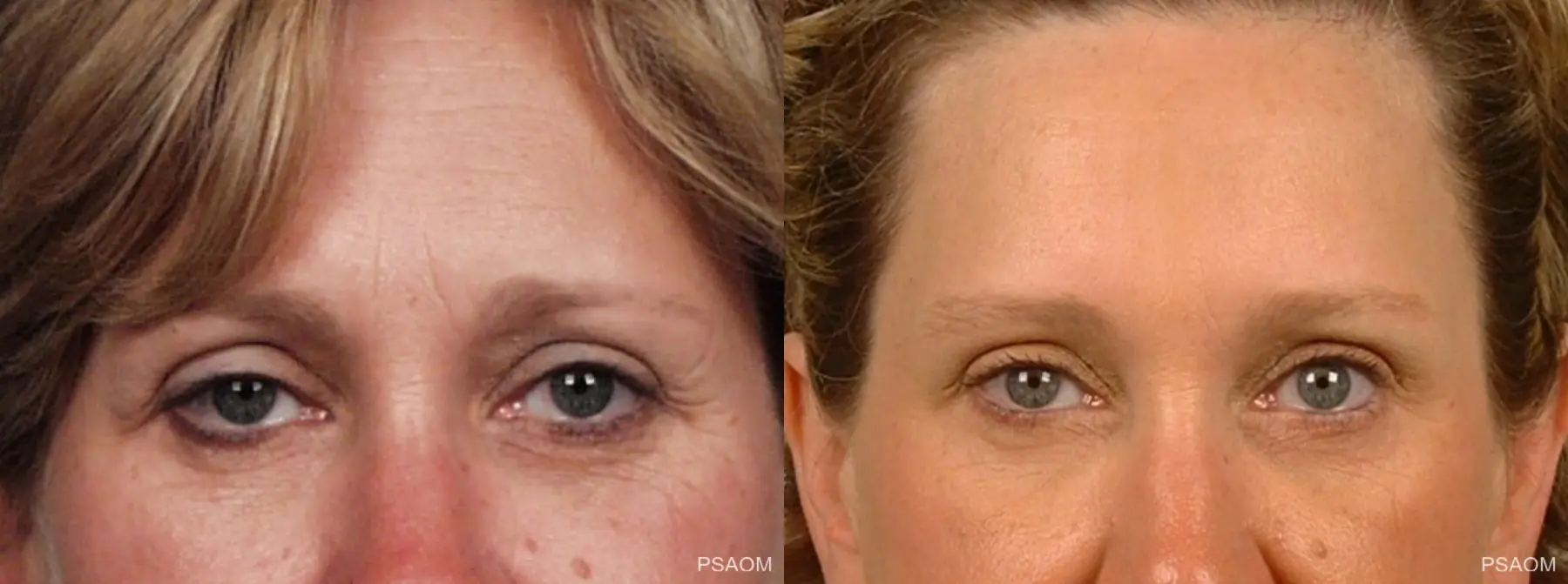 BOTOX® Cosmetic: Patient 1 - Before and After  