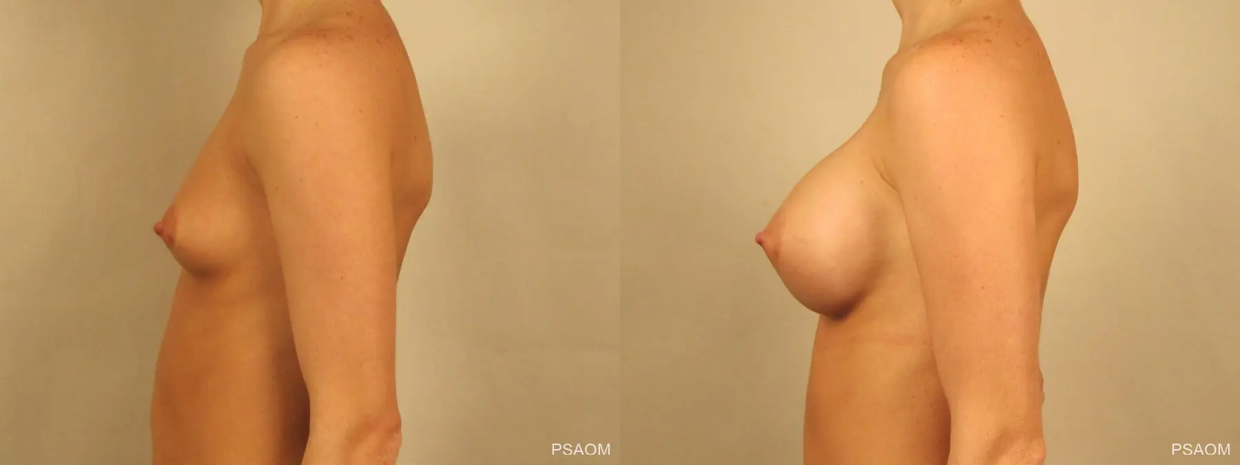 Breast Augmentation: Patient 2 - Before and After 2