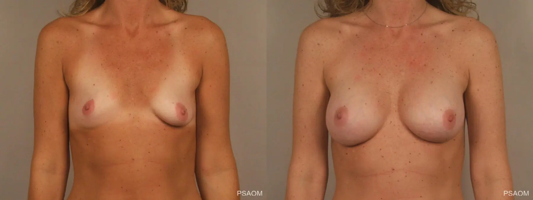 Breast Augmentation: Patient 3 - Before and After  