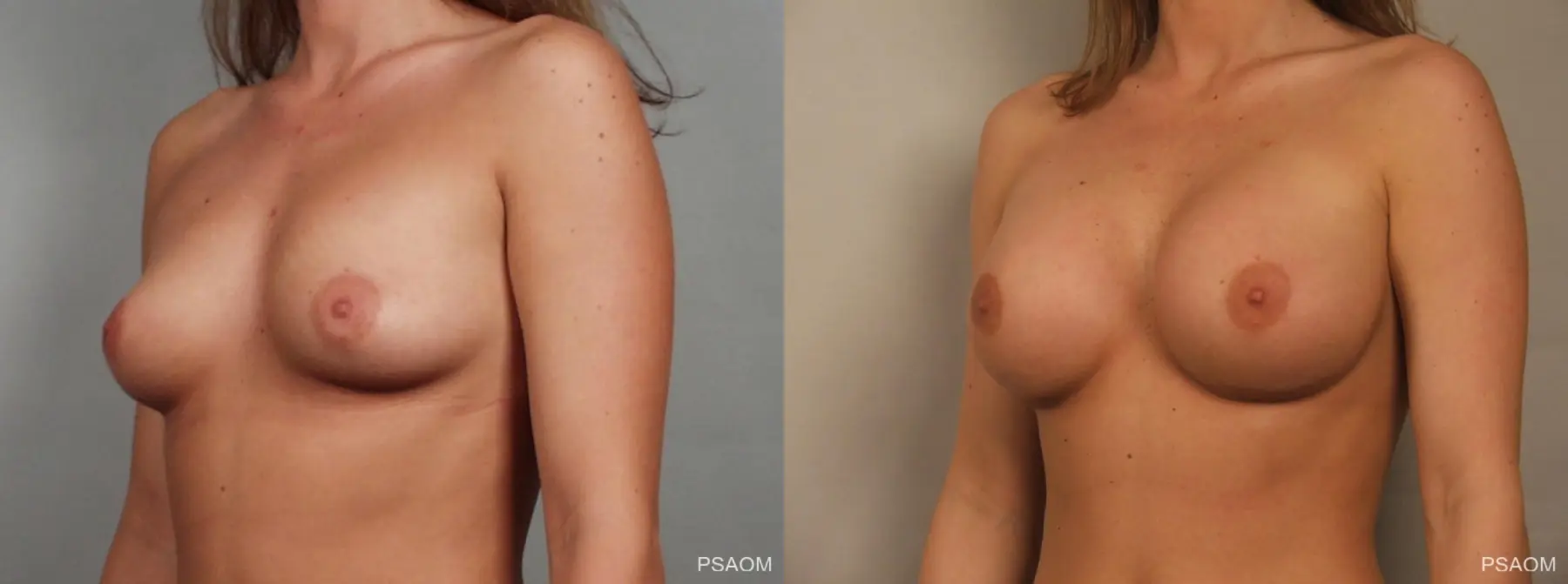 Breast Augmentation: Patient 1 - Before and After 3