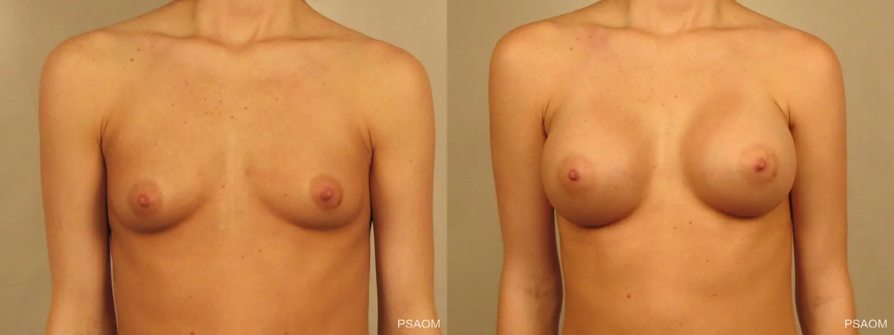 Breast Augmentation: Patient 2 - Before and After  