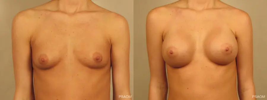 Breast Augmentation: Patient 2 - Before and After 1