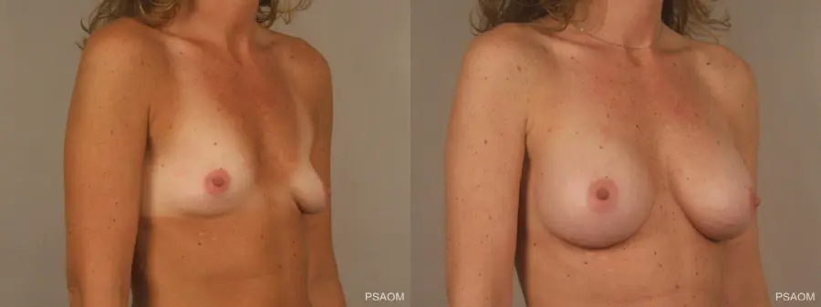 Breast Augmentation: Patient 3 - Before and After 3