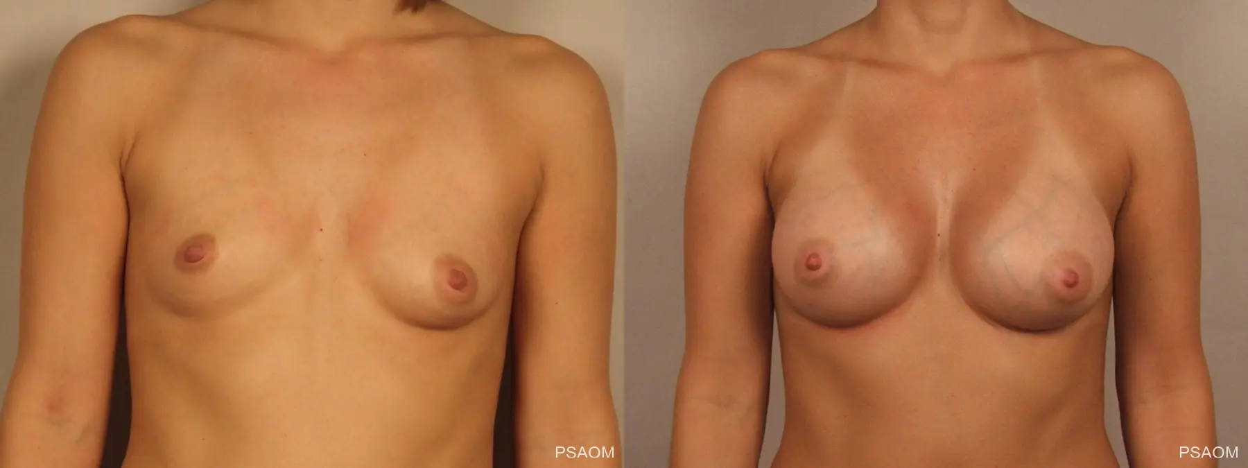 Real Montgomery breast augmentation results - Before and After
