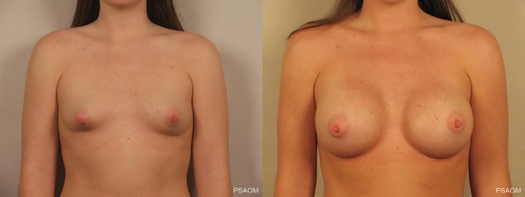 Breast Augmentation: Patient 7 - Before and After  