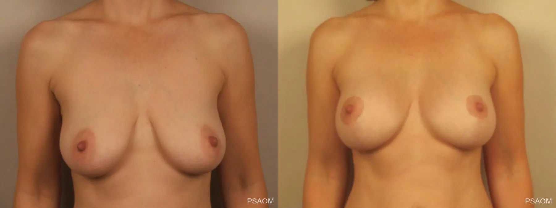 Breast Augmentation With Lift: Patient 1 - Before and After  