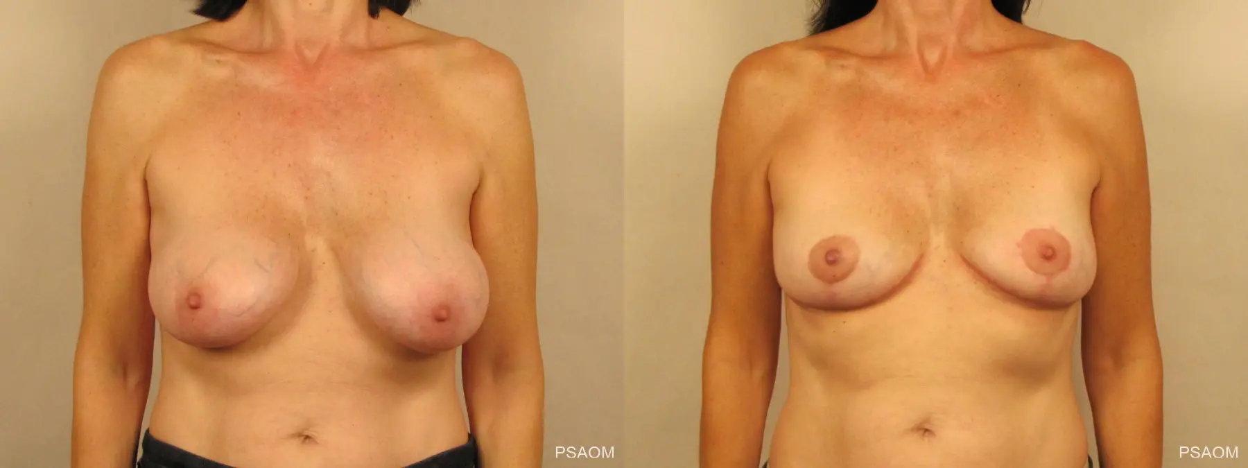 Breast Implant Removal With Lift: Patient 1 - Before and After  