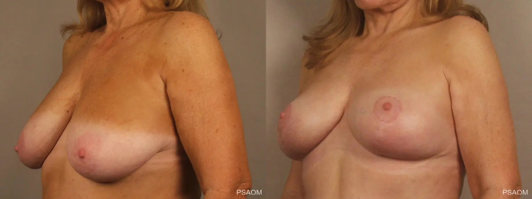 Breast Lift: Patient 1 - Before and After 3