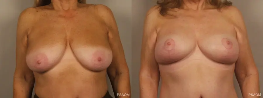 Breast Lift: Patient 1 - Before and After 1