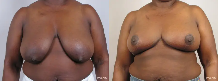 Breast Reconstruction: Patient 1 - Before and After  