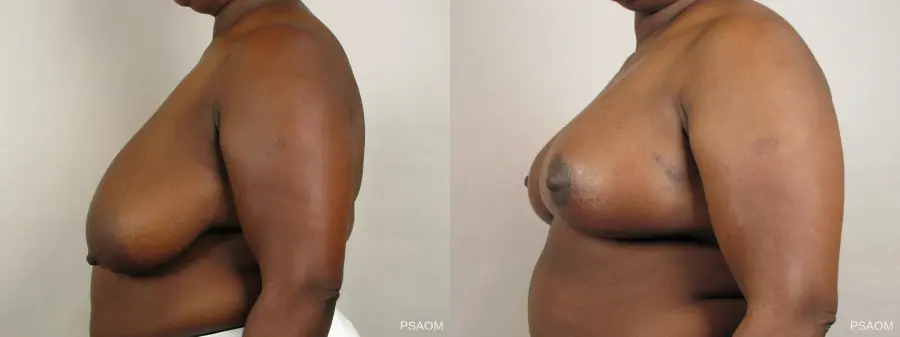 Breast Reconstruction: Patient 1 - Before and After 2