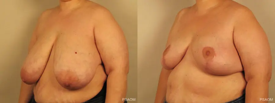 Breast Reduction: Patient 7 - Before and After 3