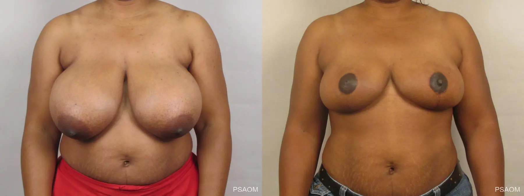 Breast Reduction: Patient 2 - Before and After  