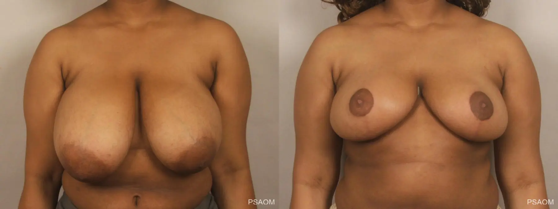 Breast Reduction: Patient 6 - Before and After 1