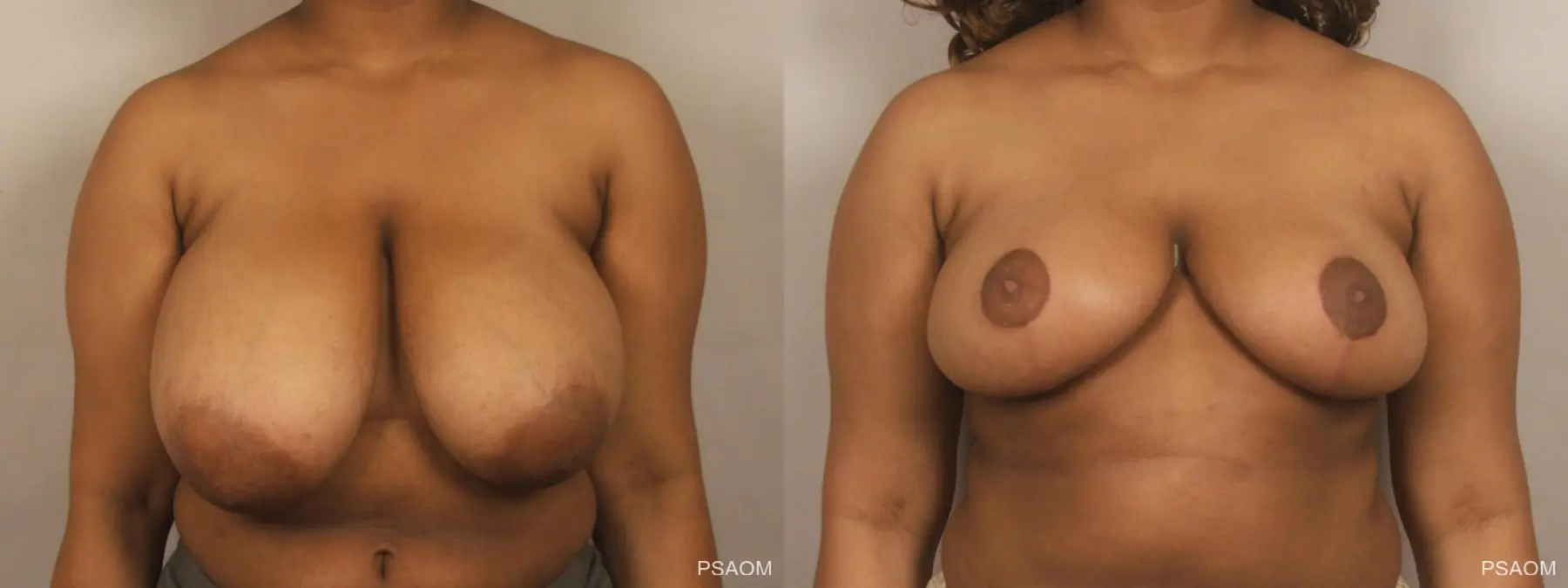 Breast Reduction: Patient 6 - Before and After  