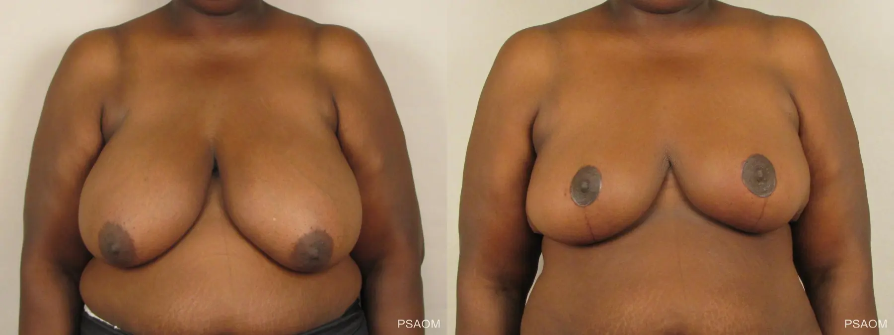 Breast Reduction: Patient 3 - Before and After  