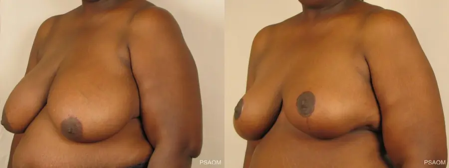 Breast Reduction: Patient 3 - Before and After 3