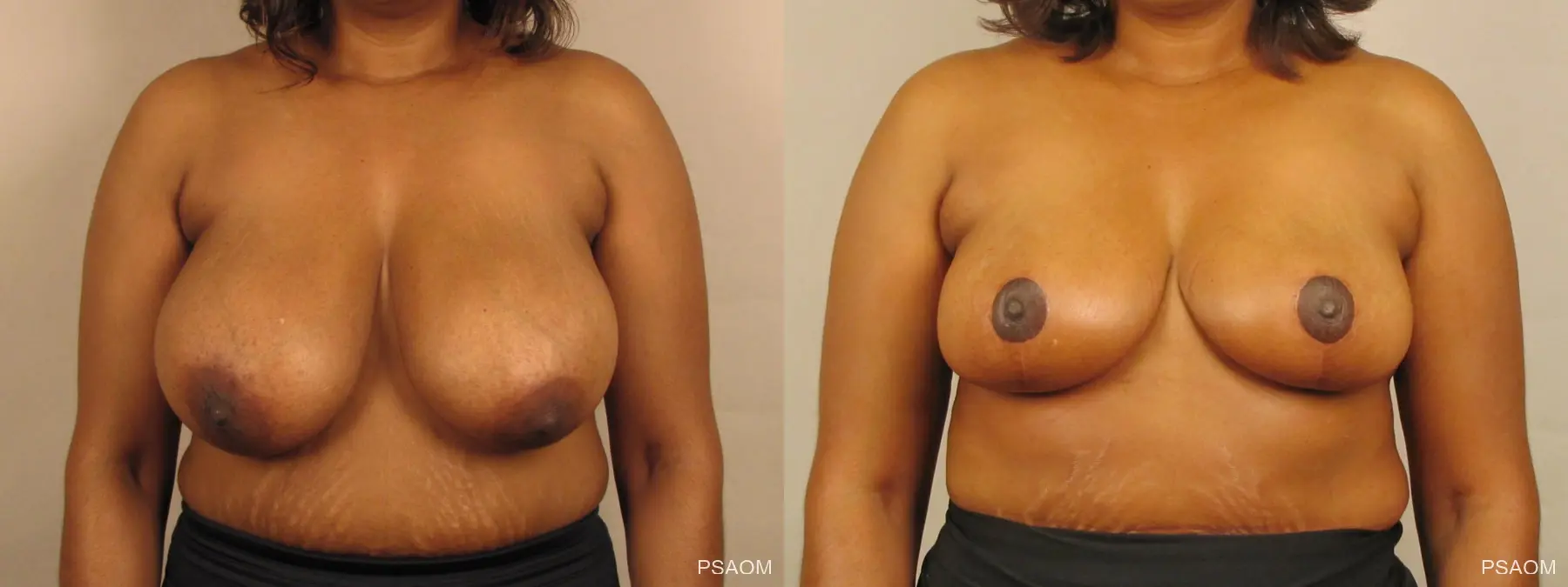 Breast Reduction: Patient 4 - Before and After  