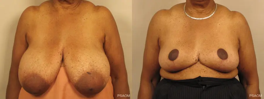 Breast Reduction: Patient 1 - Before and After