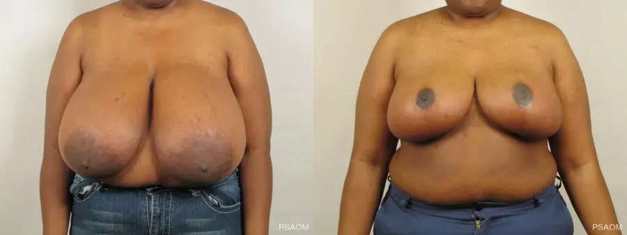 Breast Reduction: Patient 8 - Before and After  