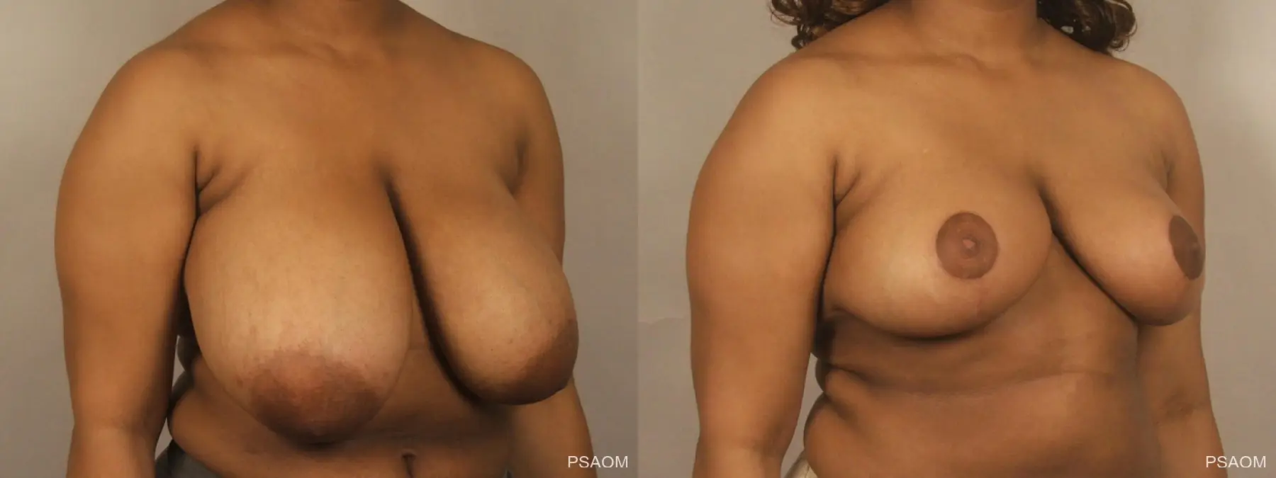Breast Reduction: Patient 6 - Before and After 3