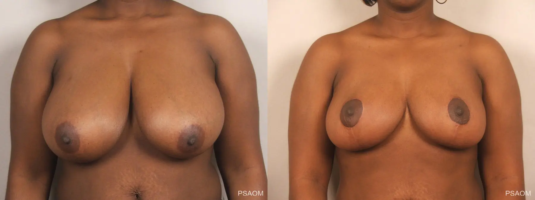 Breast Reduction: Patient 12 - Before and After  