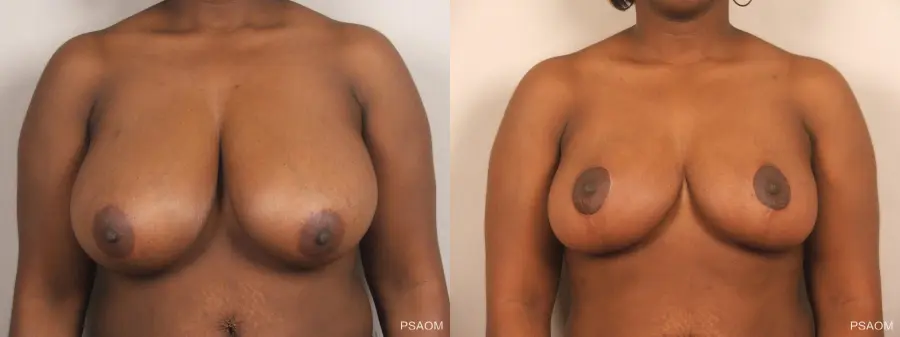 Breast Reduction: Patient 12 - Before and After