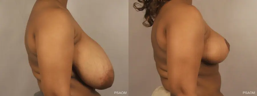 Breast Reduction: Patient 6 - Before and After 2