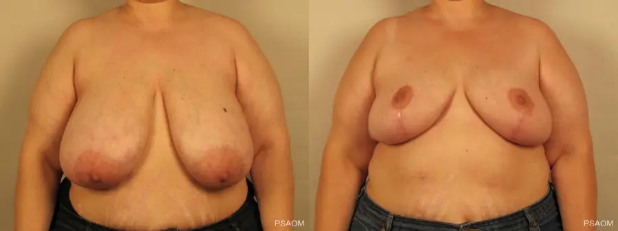 Breast Reduction: Patient 7 - Before and After 1