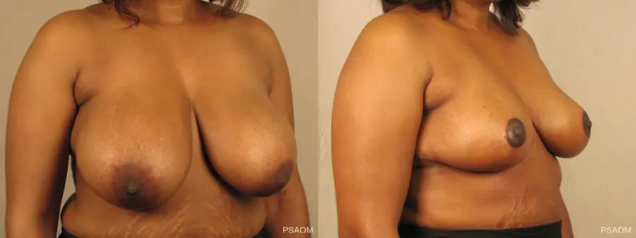 Breast Reduction: Patient 4 - Before and After 3