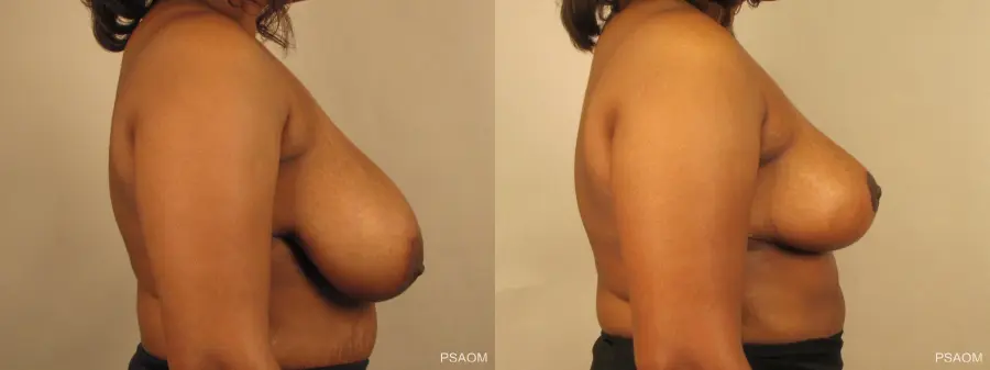 Breast Reduction: Patient 4 - Before and After 2