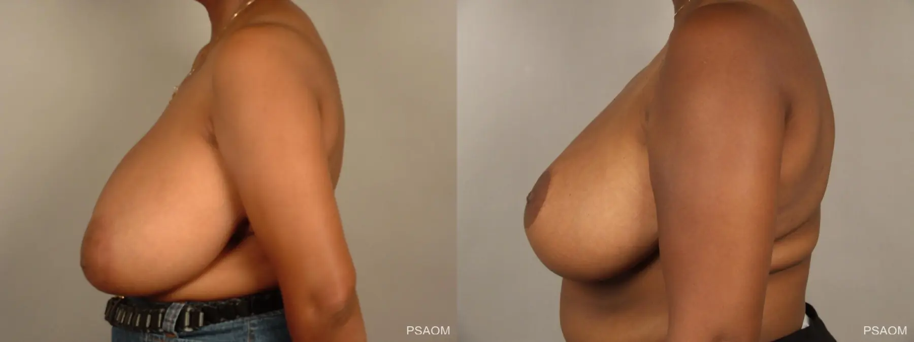 Breast Reduction: Patient 9 - Before and After 2