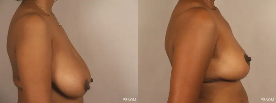 Breast Reduction: Patient 13 - Before and After 2