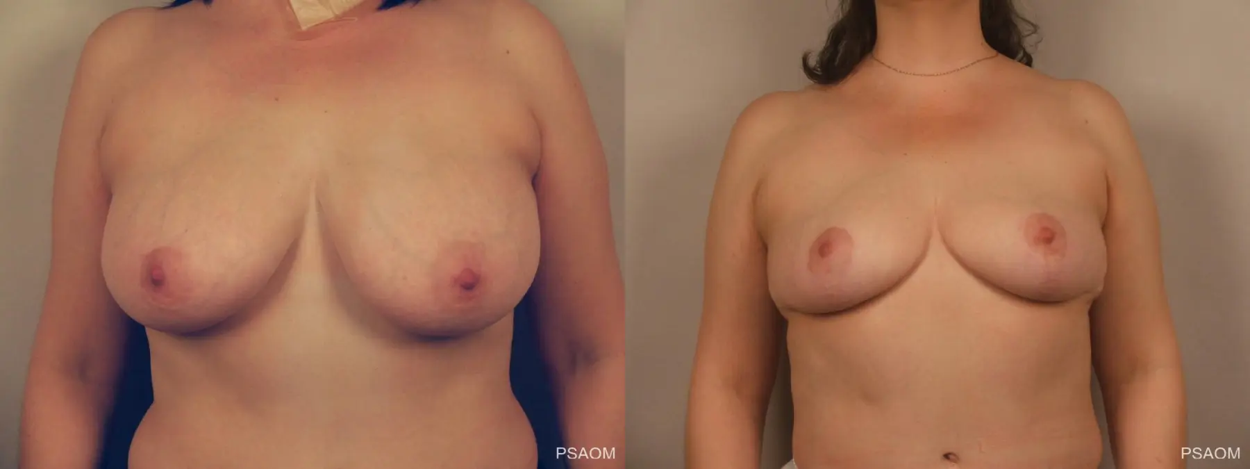 Breast Reduction: Patient 5 - Before and After 1